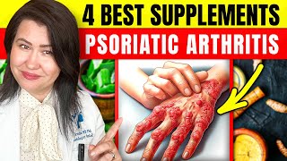 4 Scientific Supplements to Improve Psoriasis Symptoms