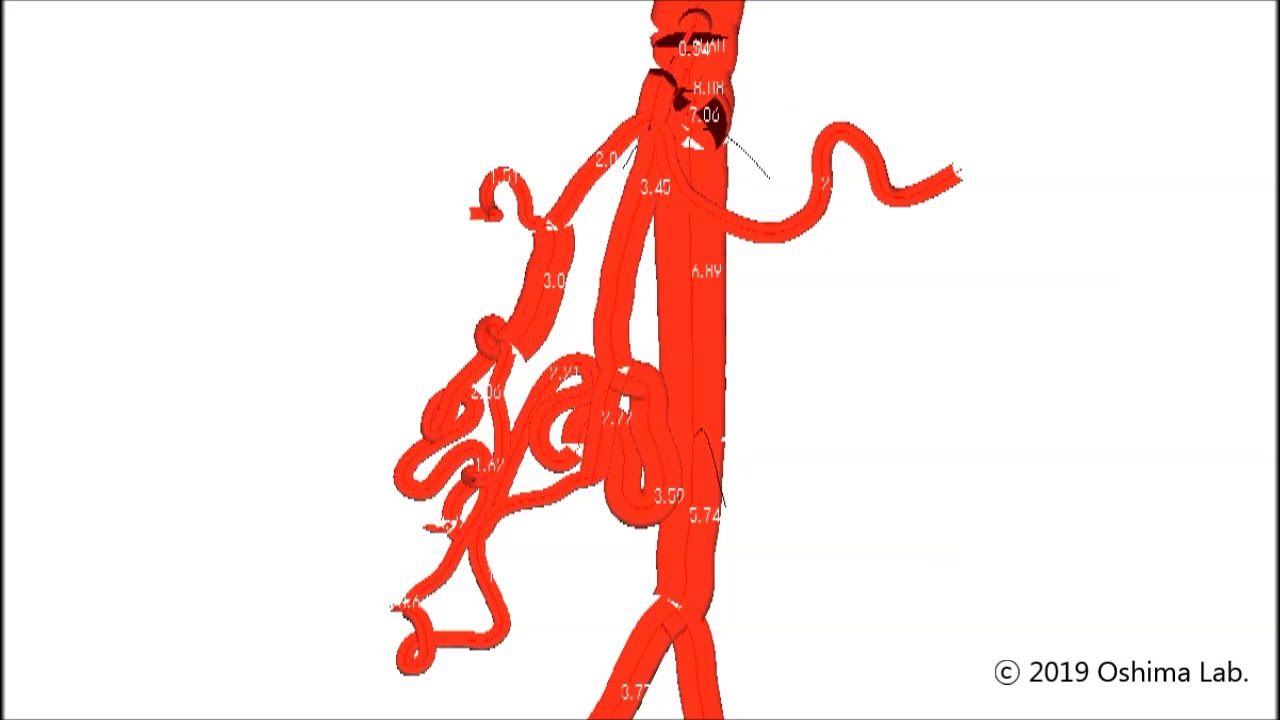 Computational simulation of vascular remodeling of the pancreaticoduodenal arcades