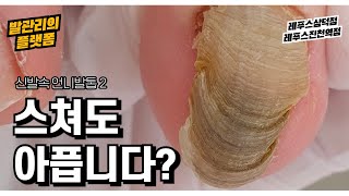 (ENG SUB) 여름에 발을 가리지 않을 당당함 찾기.  문제성 발톱제거 (athlete&#39;s foot toenail fungus / 대구레푸스삼덕점, 레푸스진천역점)
