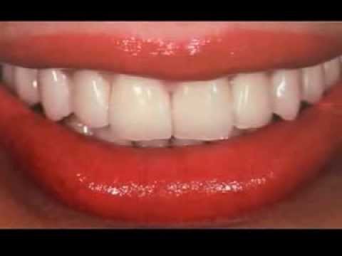 Zahnfarbe a3 zu dunkel