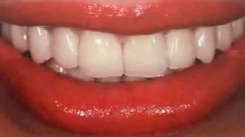 Welche Farbe für Zahnkronen?