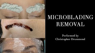 Fixing Botched Microblading: How I Correct Bad Eyebrow Tattoos by celebrity cosmetic tattoo artist