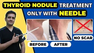 THYROID NODULE TREATMENT WITHOUT SURGERY | COLLOID GOITER TREATMENT | LIVE by Dr  Gaurav Gangwani