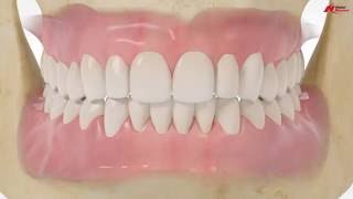 New concept in tissue level treatment