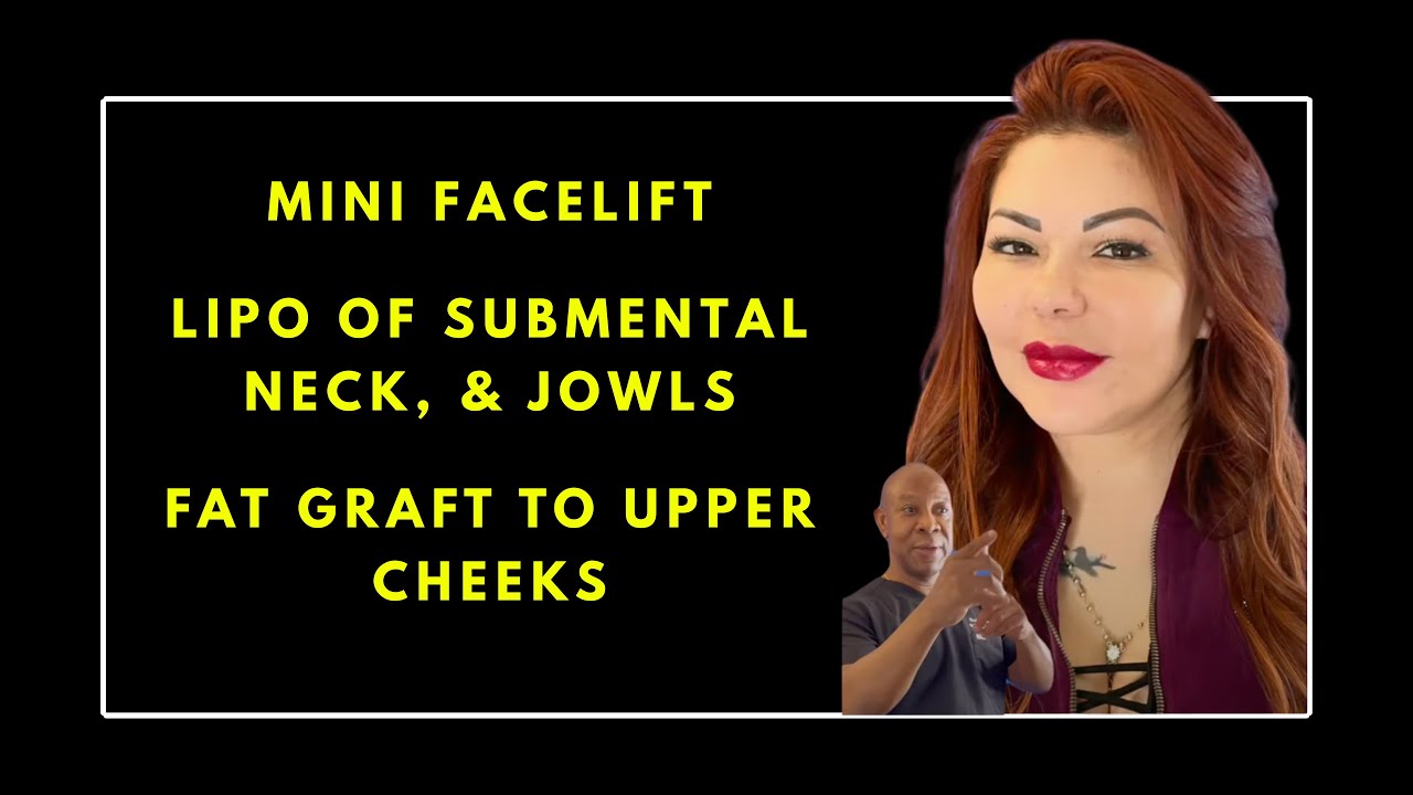 Mini facelift, Lipo Submental, Neck & Fatgrafting to Upper cheeks