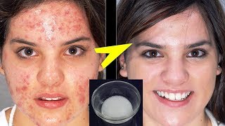 In 3 DAYS-Remove DARK SPOTS Permanently / Chehre se daag dhabe khatam karne ka tarika/ Acne marks