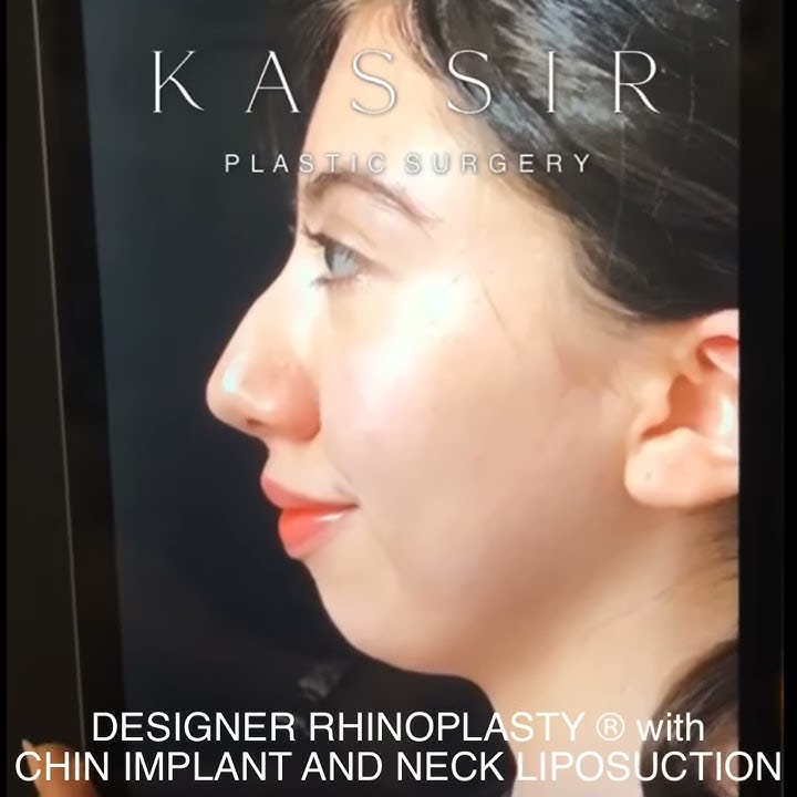 Designer Rhinoplasty/ Chin Implant and Liposuction of the neck by Dr. Kassir