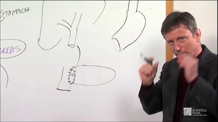 Whipple Operation Description | Roswell Park Patient Education