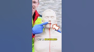How to Stop a Nosebleed the Right Way!