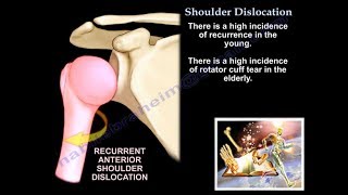 Shoulder Dislocation Associated Lesions - Everything You Need To Know - Dr. Nabil Ebraheim