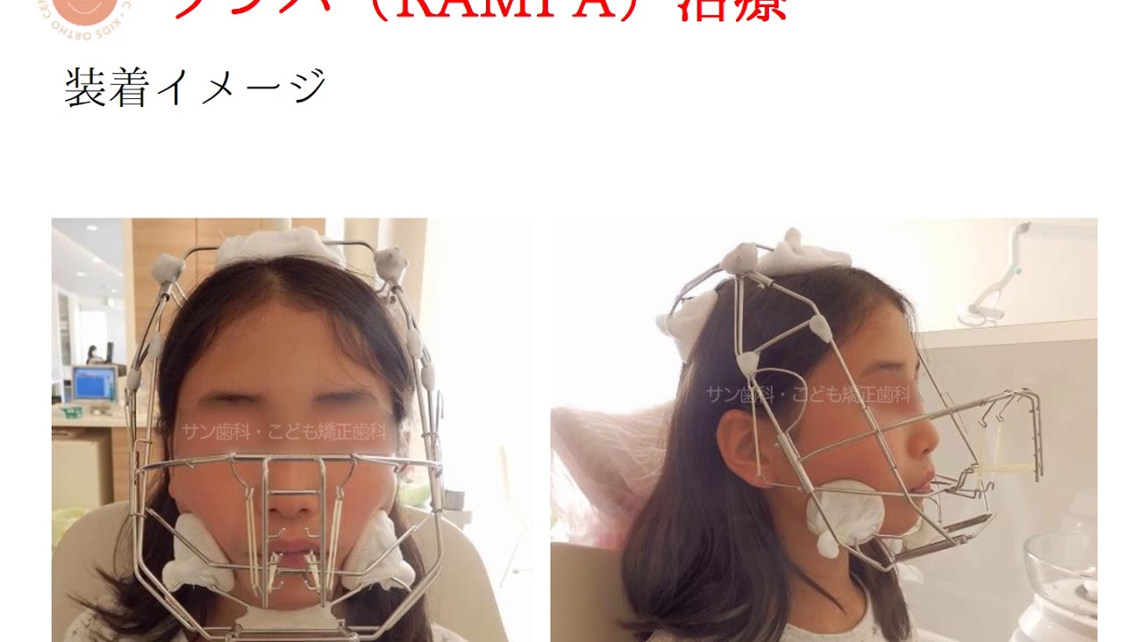 相模原市のサン歯科 こども矯正歯科のランパ治療 Youtube