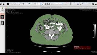 VISOR DICOM OSIRIX : HOROS 13 (Cálculo del volumen de grasa abdominal)