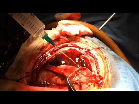 subdural hematoma surgery الورم الدموي تحت الجافية