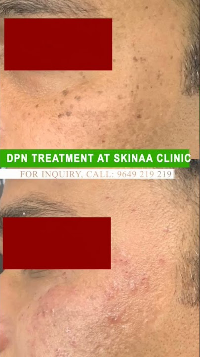 DPN Treatment at Skinaa Clinic #DPN #dpntreatment #ytshorts #viral #shorts #skinaaclinic #dpn