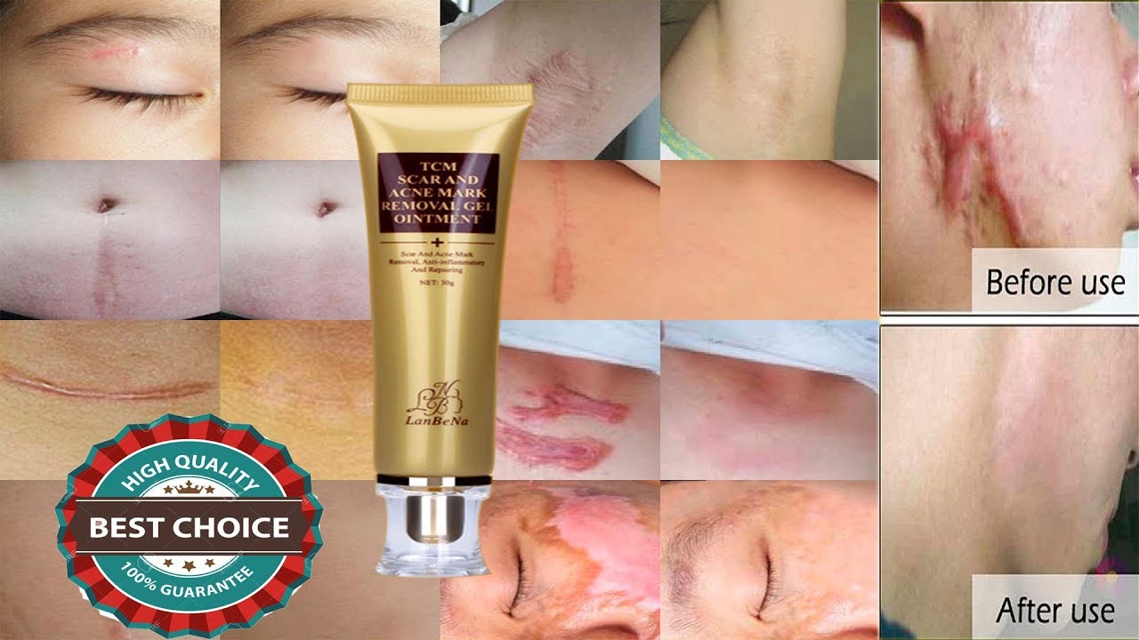 Best Scar Removal Treatment Best Scar Removal Creams Exactly What