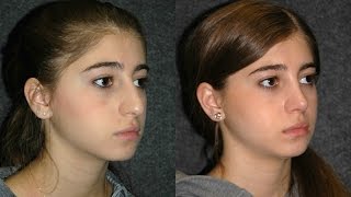 Rhinoplasty Before and After on Young Woman NYC Dr Andrew Jacono Reviews