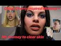 Alexandra French x Chloe Cherry Makeup Tutorial ft. My Accutane Journey