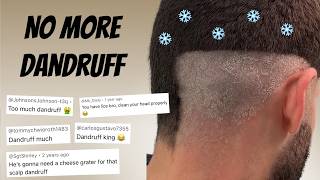 How I Got Rid Of My Dandruff/Seborrheic Dermatitis In 1 Week (2026 Update)