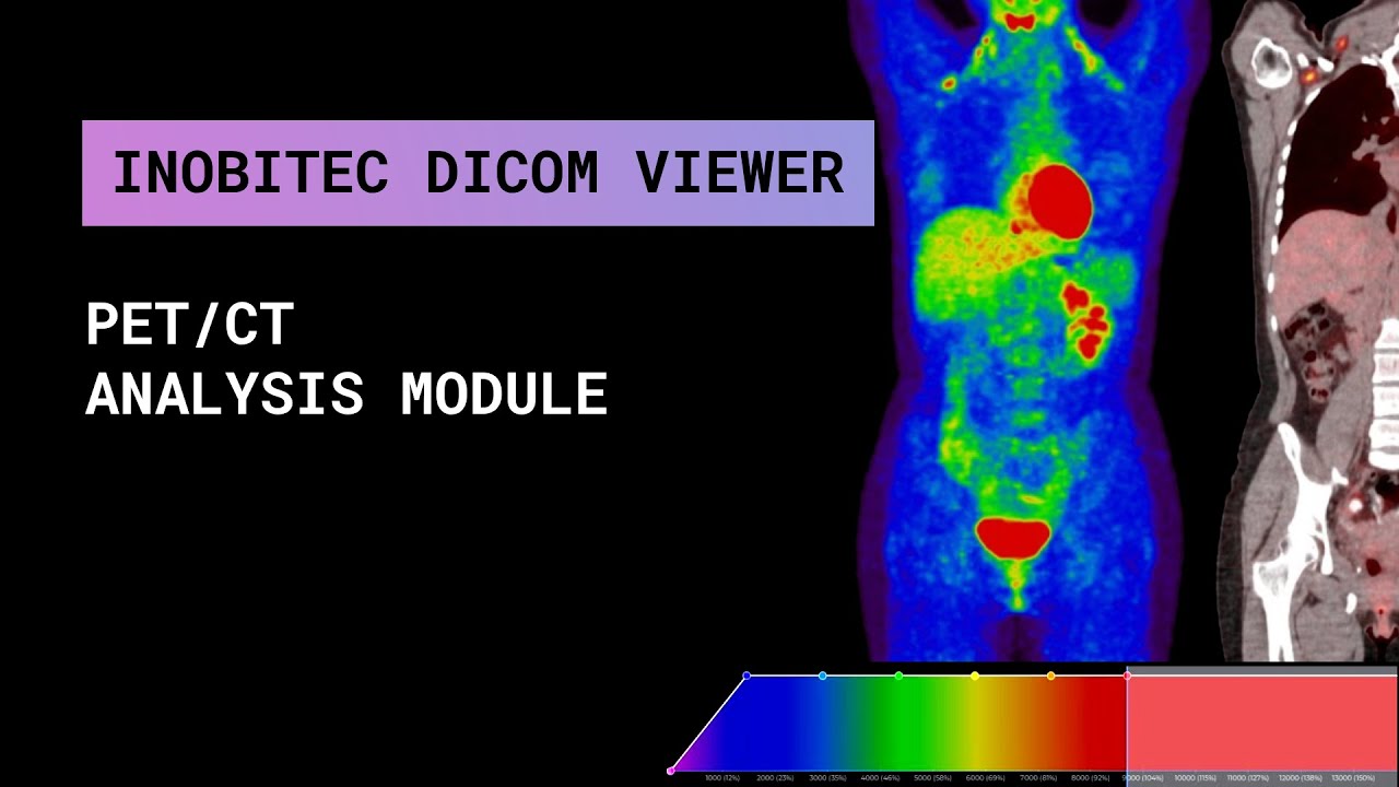 PET/CT analysis module of Inobitec DICOM Viewer Pro - YouTube
