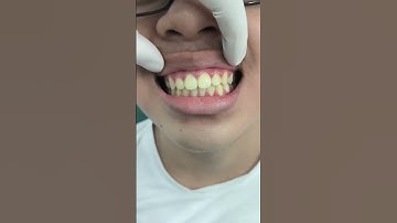 Tháo mắc cài nè #chinhnha #dentist #niengrang