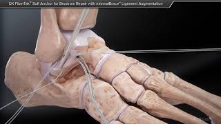 DX FiberTak<sup>®< sup> Soft Anchor for Brostrom Repair with InternalBrace™ Ligament Aug screenshot 4