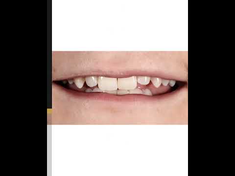 Ultra Thin Veneers Fitting