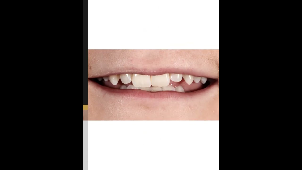Ultra Thin Veneers Fitting