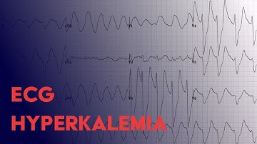 Hyperkalemia EKG Findings - ECG Interpretation