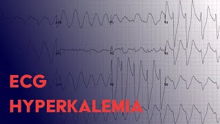 Hyperkalemia EKG Findings - ECG Interpretation