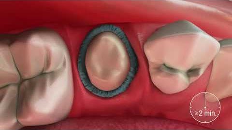 Gingival Retraction Paste