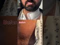 Thyroid Before And After Surgery Video Drbakhtzada 