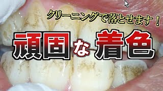 【着色汚れ】前歯をピカピカに