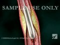 Balloon angioplasty  anc00203