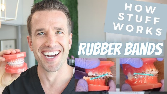 How do elastic rubber bands for braces work? – Somos Dental