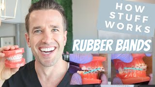 Rubber Bands | Orthodontic Rubber Bands | Braces with Dr. Nate