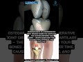 Joint pain slowing you down? It could be osteoarthritis #orthopaedicsurgeon  #spinespecialist