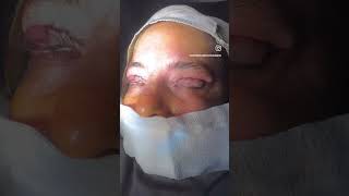 Blepharoplasty surgery in lahore Pakistan by dr Saleem
