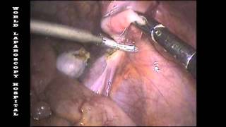 Laparoscopic Orchiectomy By Dr R K Mishra