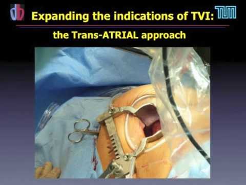 Video: Valve Ya Moyo Kupunguza (Mitral Na Tricuspid) Katika Paka