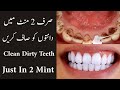 How To Clean Dirty Teeth In 2 Mint At Home | Very Fast Way To Clean Dirty Teeth At Home |dant clean