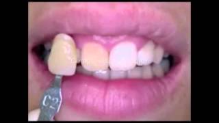 Blanqueamiento Dental Interno