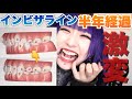 【経過レポ#3】インビザラインを始めてから半年が経ったけど変化がやばい。
