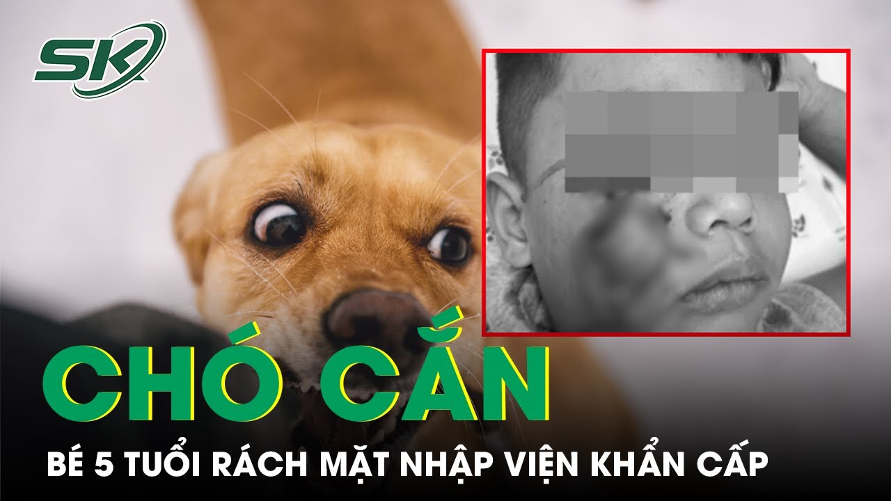 Bé 5 tuổi bị chó cắn rách mặt, cảnh báo liên tiếp nhiều trẻ cấp cứu vì ...