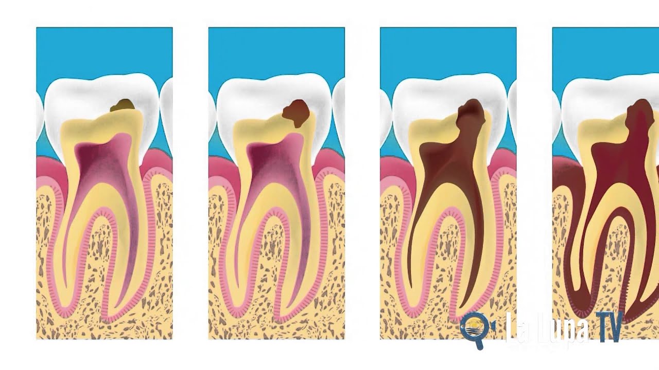 Как Выглядит Кариес На Зубах Фото – Telegraph