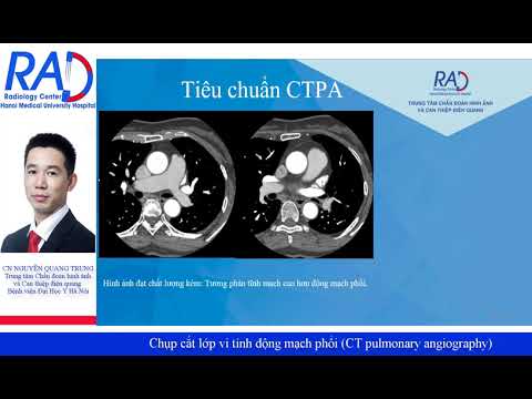 Kỹ thuật chụp cắt lớp động mạch phổi tránh bỏ sót tắc động mạch phổi (CT pulmonary angiography)