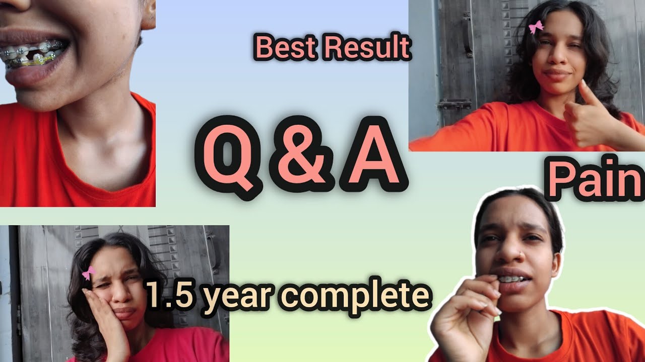 Q & A ll braces update #bracestransformation #braces #bracesjourney #youtube 