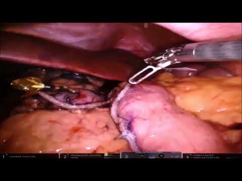 A Novel Technique of SureForm–Based Intrathoracic Esophago-Gastric Anastomosis in RAMIE