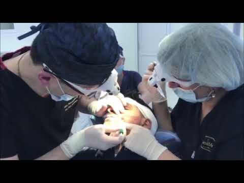 Deamed - წვერის გადანერგვა კლინიკა \'დეამედში\' - Beard Transplant in Georgia