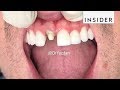 How Dentists Create Tooth Veneers And Crowns