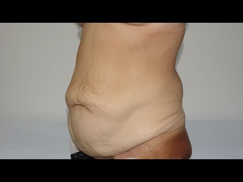 Video: Abdominoplastika Trbuha - Pregledi, Prije I Poslije